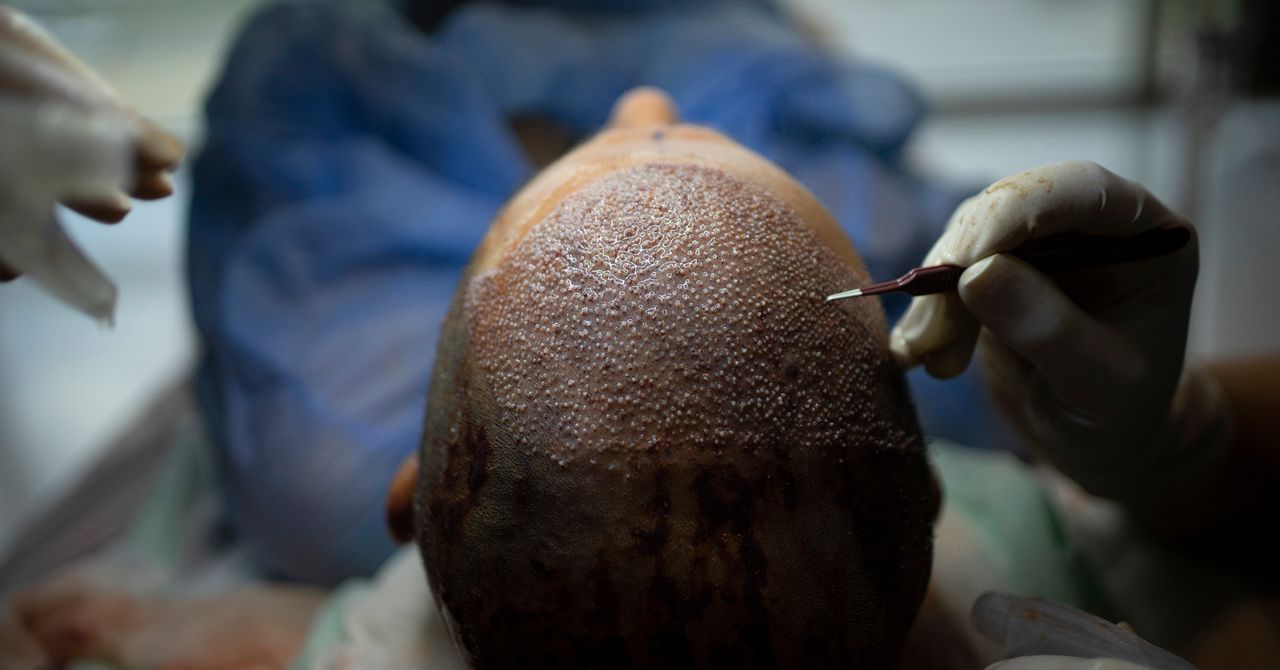 A close-up image of a surgeon meticulously performing a hair transplant procedure on a patient's scalp.
